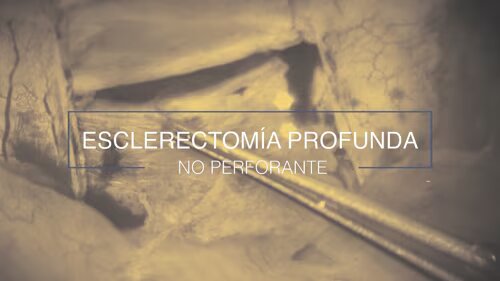 Esclerectomía Profunda video-min