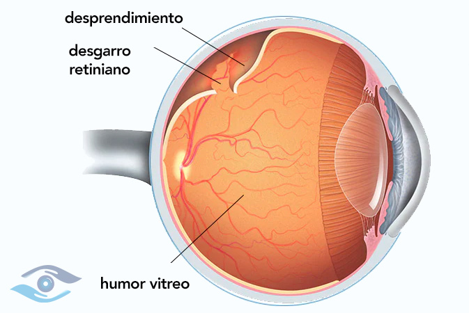 Retina y vitreo