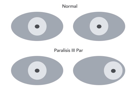 Parálisis Oculomotor